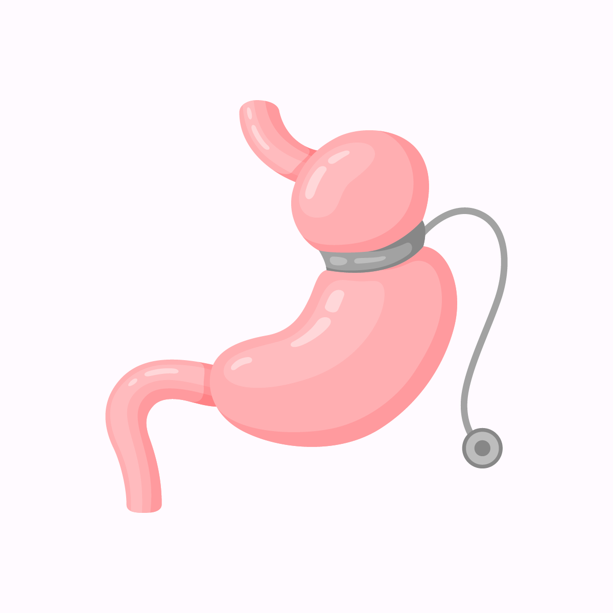 Intervention de chirurgie de l'ob&eacute;sit&eacute; - Anneau gastrique ajustable