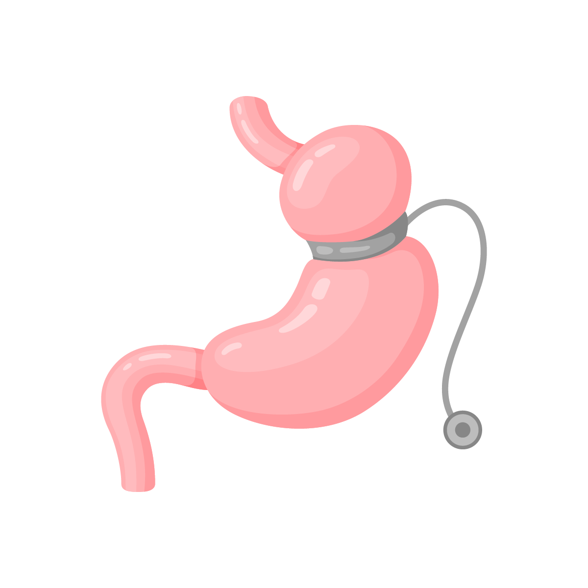 Intervention de chirurgie de l'obésité - Anneau gastrique ajustable