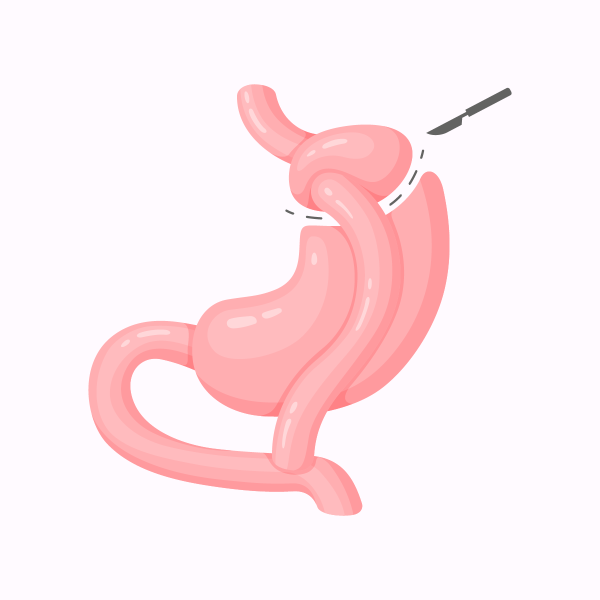 Bypass : Court-circuit gastrique