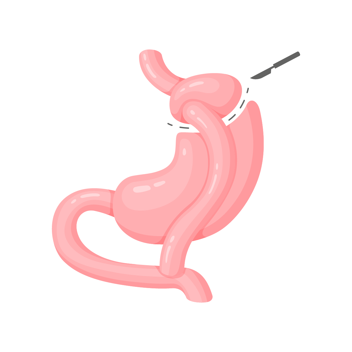 Bypass : Court-circuit gastrique