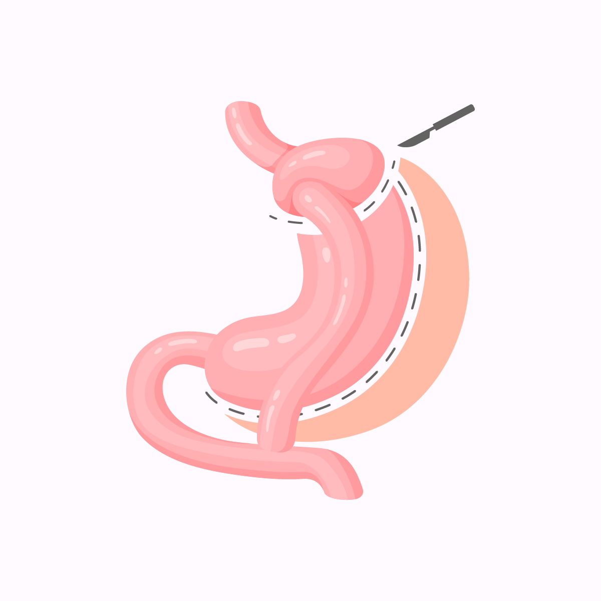 D&eacute;rivation Biliopancr&eacute;atique