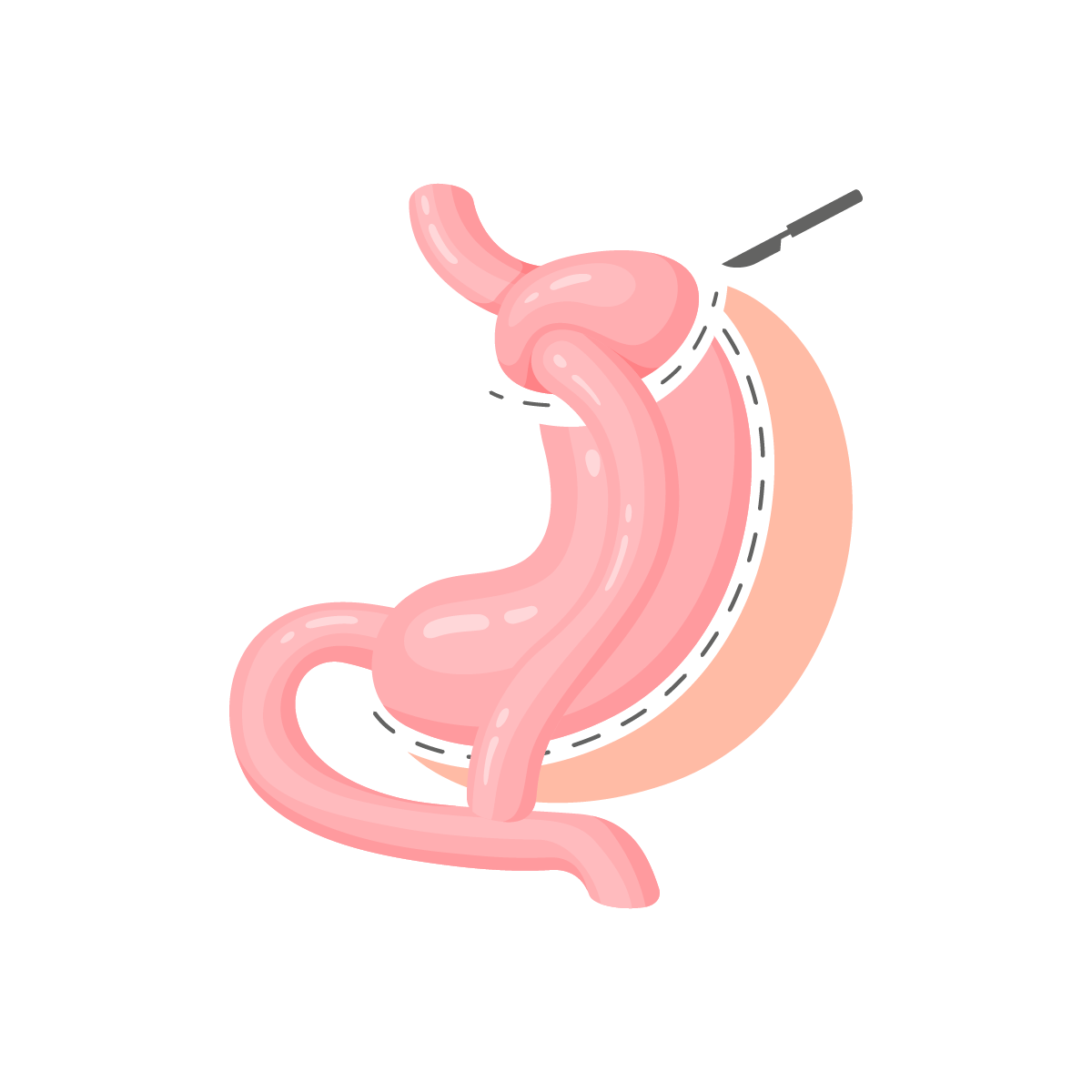 Dérivation Biliopancréatique