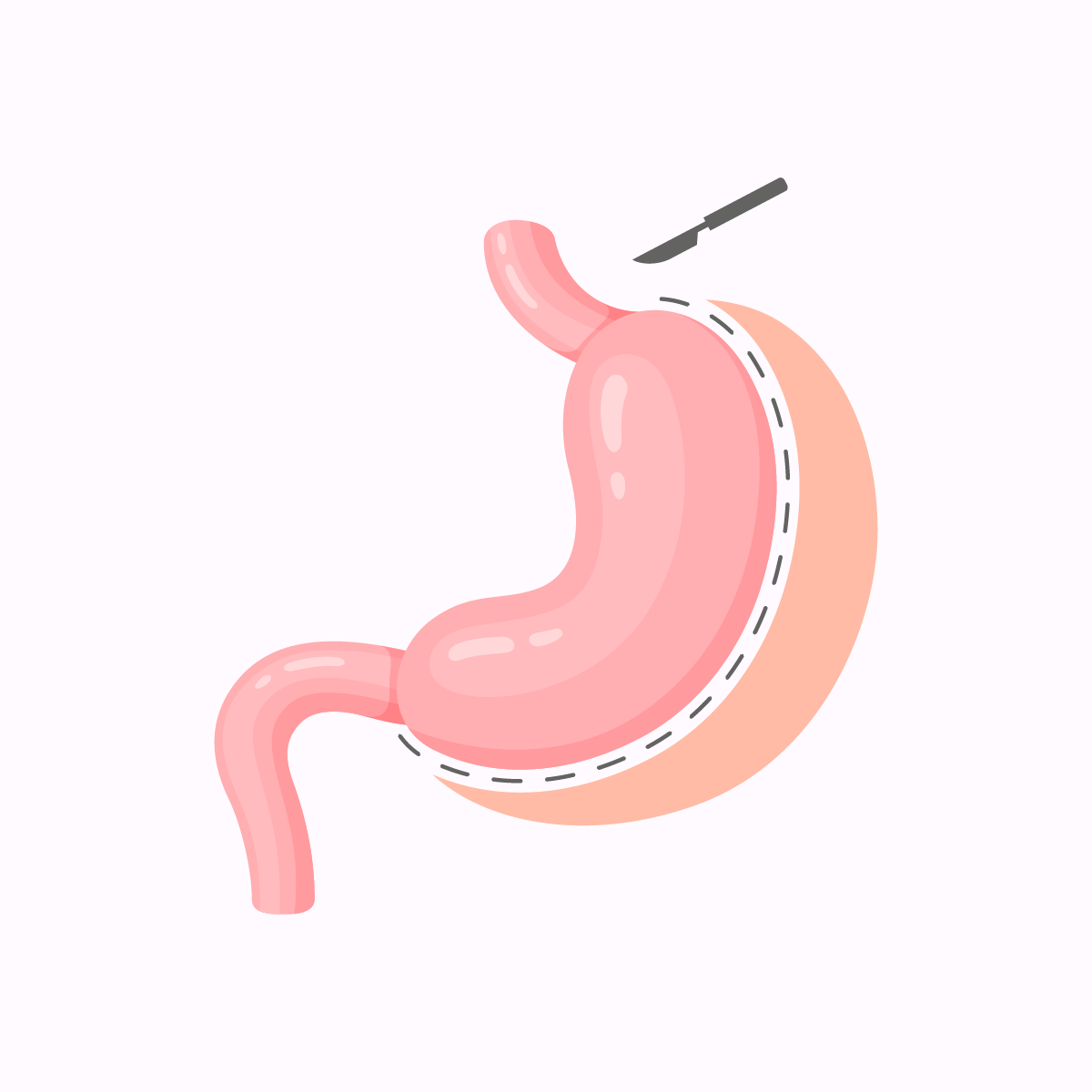 Intervention de chirurgie de l'ob&eacute;sit&eacute; - Sleeve gastrectomie